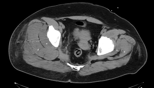 Axial view of the maximum thickness of the left gluteus minimus and medius muscles on CT. The right side is about three times thicker than the left side with respect to the gluteus minimus (*) and the gluteus medius (#).