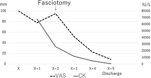 The course of VAS and CK. After fasciotomy, both are rapidly decreasing.