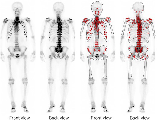 Bone scintigraphy shows numerous accumulations in the thoracolumbar spine, pelvis and ribs.