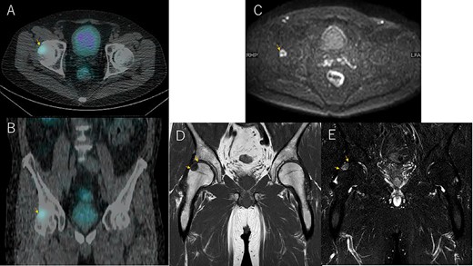 Somatostatin receptor scintigraphy shows a pale accumulation at 24 h (A and B). MRI diffusion-weighted images show a high-signal change in axial (C) consistent with the accumulation site (A). T1-weighted images (D) and STIR (E) in coronal.