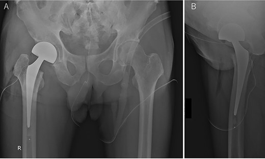 Postoperative anterior–posterior radiographic view of the both hip joints (A) and lateral view of the right hip joint (B).