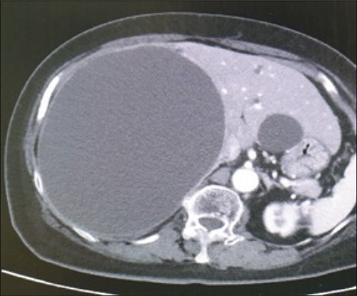 Preoperative computed-tomography imaging demonstrating giant liver cyst (axial section).