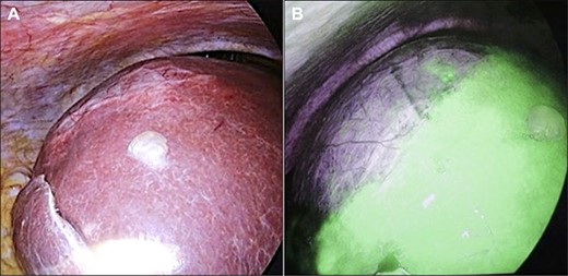 Intraoperative findings. (A) A giant cyst was confirmed in the abdominal cavity. (B) At ~1 h after ICG injection, the liver parenchyma showed strong fluorescence signals.