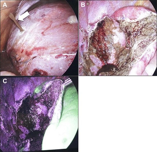 Intraoperative findings. (A) When puncturing a cyst, an outflow of brown cyst fluid was observed (arrow). Confirmation at the bottom of the cyst after fenestration procedure. Images obtained under normal light (B) and near-infrared light (C). There was no evidence of bile leakage upon macroscopic observation.