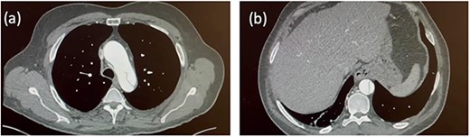 Initial CT aortogram. Aortic dissection originating from the origin of left subclavian artery with the ascending aorta measuring 45 mm (a). The dissection extends to involve the descending aorta and abdominal aorta (b).