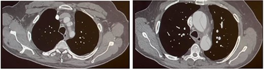Follow-up CT aortogram. Aortic dissection extending into the left common carotid artery and involving the left subclavian artery without compromising the lumen. The ascending aorta has further dilated from Fig. 1 to now measure ~51 mm.