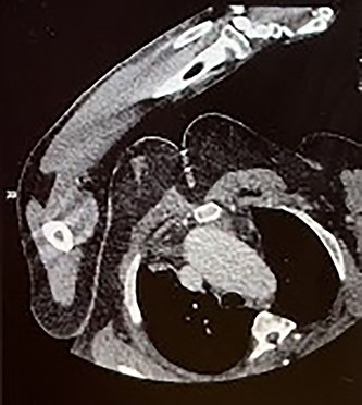 CT aorta thorax on patient’s re-admission four months later. Ascending aortic aneurysm has increased in size (measuring 60 × 61 mm) compressing the trachea.