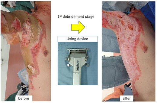 A first-stage debridement for eschar using an electric dermatome (0.4-mm thickness) was performed 12 h after the burn injury.