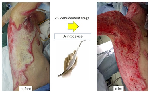 A second-stage debridement for slough using the Versajet™ hydrosurgery system (power setting: 5–10) was performed as a late surgery.