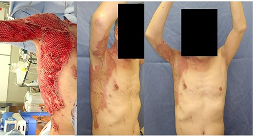 Mesh auto-grafts were applied, and an excellent range of motion was obtained without contracture after 8 weeks.