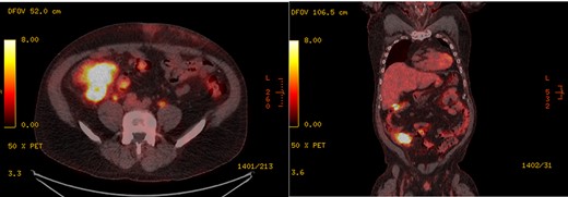 PET scan showing intense activity in the RLQ inseparable from the cecum and appendix, found to be acute appendicitis with XGI on histopathology of appendix specimen, in (left) axial section and (right) coronal section.
