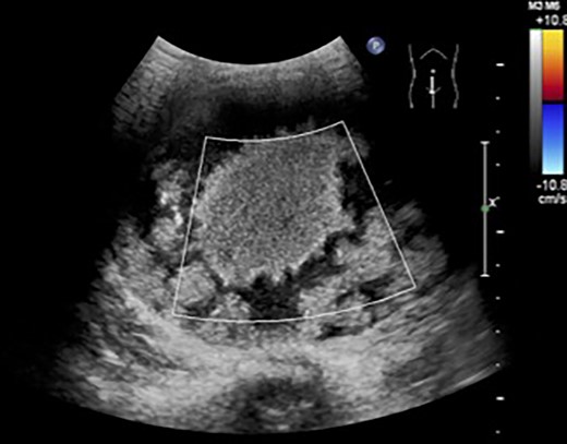 Abdominal ultrasonography revealed a large mass centered in her lower abdomen. The tumor border was clear, the internal structure was heterogeneous and the blood flow was poor.