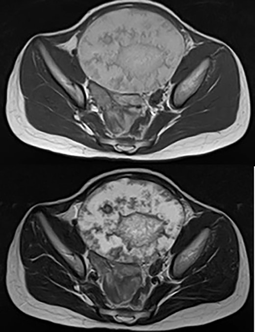 Abdominal magnetic resonance imaging revealed a cystic mass 10 cm in diameter with high intensity on T1-weighted images (upper) and high intensity on T2-weighted images (lower).