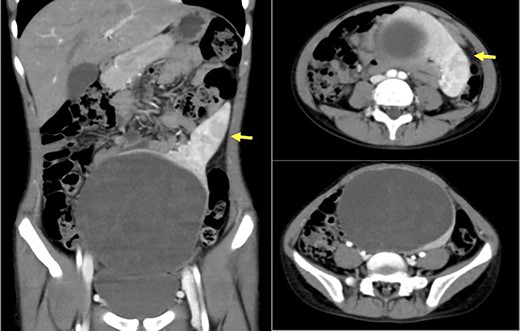 Abdominal computed tomography revealed a spleen (arrows) near the navel and a cystic lesion with poor contrast that continued from the lower pole of the spleen.