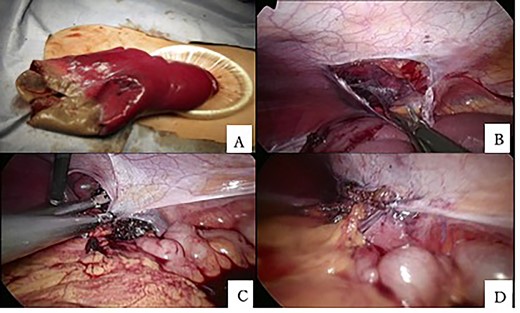 (A) The spleen could be externalized by aspiration of the cyst contents through an umbilical incision. (B) A retroperitoneal pocket was created under the left diaphragm laparoscopically. (C, D) The superior pole of the spleen was placed in the retroperitoneal pocket and fixed.