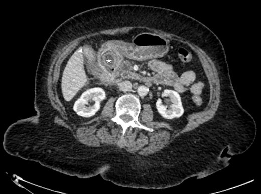 CT scan showing the stone impacted in the first part of duodenum.