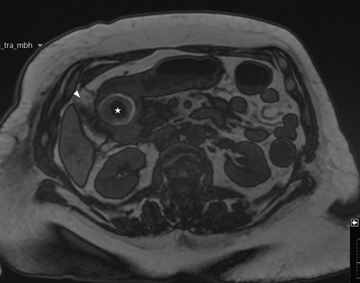 MRI scan showing the gallbladder adherent to the duodenum with an impacted stone in the duodenum.