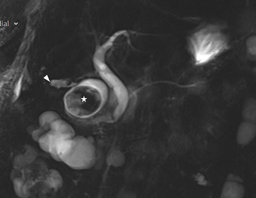 Coronal view of the MRI showing normal biliary tree.