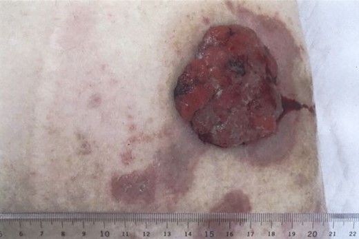 The mass was hemorrhagic, and protruded from the stoma scar.