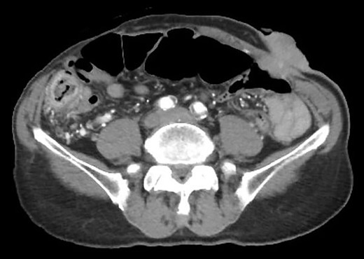 Computed tomography showed irregular mass at the abdominal wall.