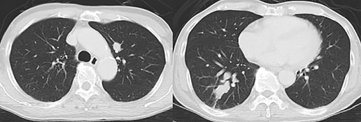 Computed tomography also showed irregular lung masses.