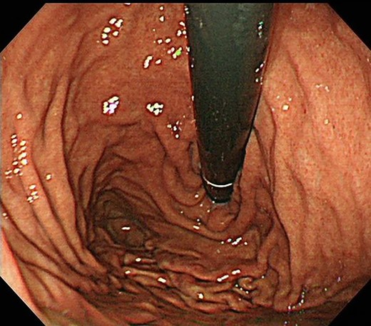 Upper gastrointestinal endoscopy revealed no neoplasm.