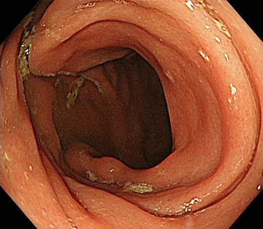 Colonoscopy also revealed no neoplasm.