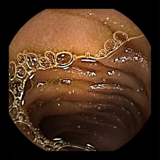 Capsule endoscopy also revealed no neoplasm.