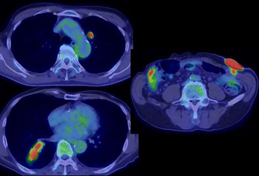 Positron emission tomography revealed an abnormal accumulation of a mass in the abdominal wall and bilateral lung.