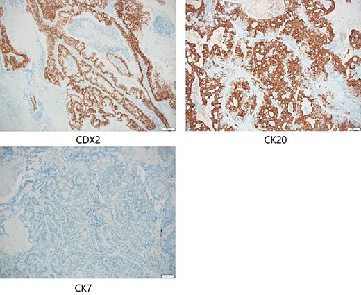 Immunostaining of biopsy specimen was strongly positive for CDX2/CK20 and negative for CK7.