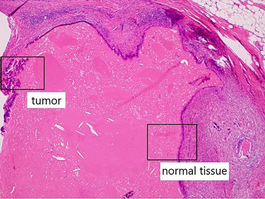 Non-neoplastic epithelial cells were present adjacent to neoplastic epithelial cells.