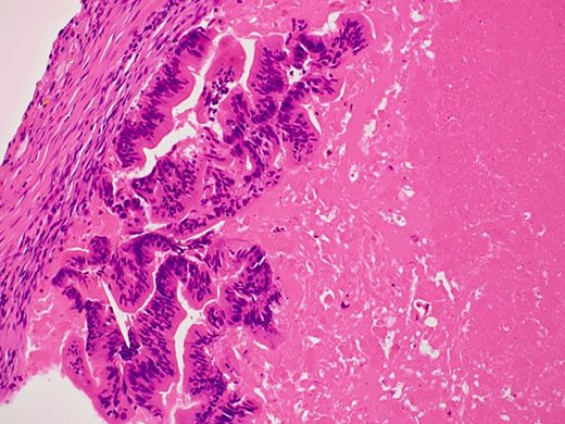 Differentiated ductal adenocarcinoma grew irregularly in a gourd-like pattern at the tumor area.