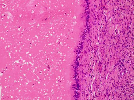 Non-neoplastic intestinal epithelium remained at the normal tissue area.