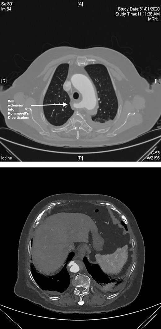 (A) CT axial slice demonstrating PAU. (B) CT axial slice IMH seen extending into the KD.