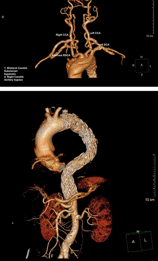 (A) 3D-CT reconstruction of extra-anatomical debranching of supra-aortic vessels with bilateral C-S bypasses. (B) 3D-CT reconstruction of thoracic endovascular repair.