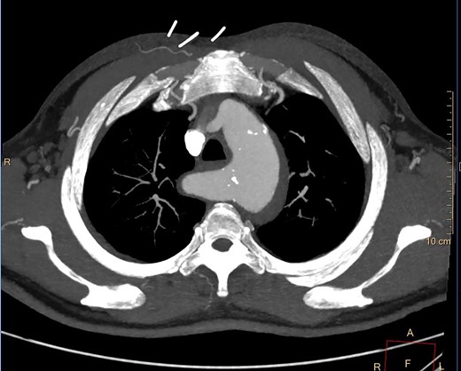 CT axial slice showing IMH involving the KD.