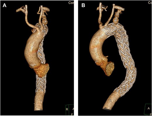 (A) 3D-CT reconstruction showing post op repair and Right subclavian to carotid transposition. (B) 3D-CT reconstruction showing post op repair and left C-S bypass.