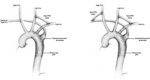 Diagram representing hybrid supra-aortic debranching, TEVAR and endovascular occlusion of subclavian origins.