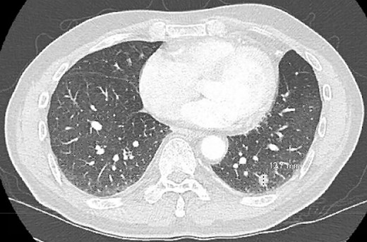 CT scan demonstrating a spiculated left lower lobe nodule.