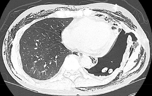 POD13 CT scan demonstrating a BPF between the fifth and sixth ribs communicating with a pneumothorax and subcutaneous emphysema.