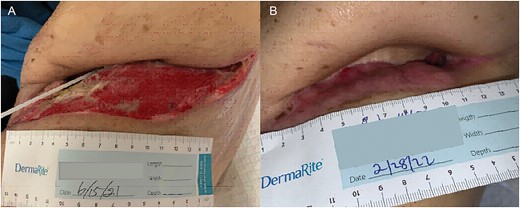 (A) POD 19 and (B) 9 months status post OWT.