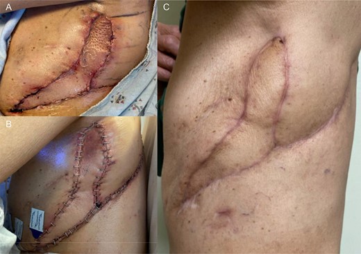 (A) POD 0 status post VRAM flap. (B) POD1 status post take back. (C) About 3 months post VRAM flap.