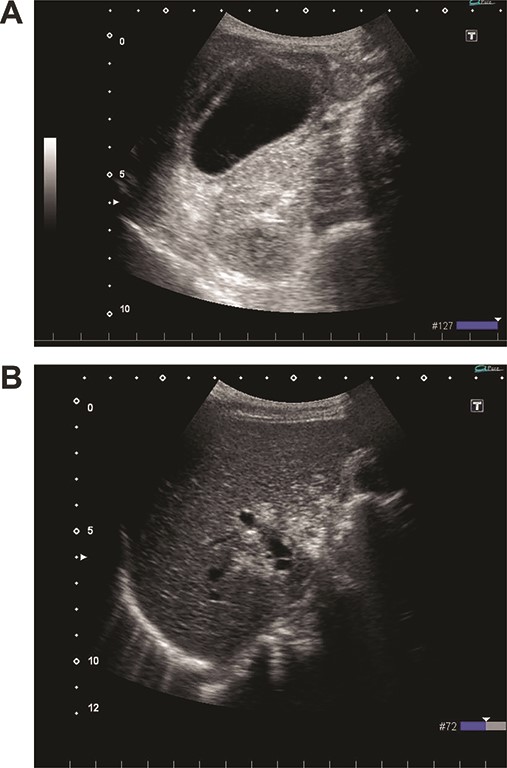 (A) Ultrasonography shows distention and wall thickening of the gallbladder. (B) Ultrasonography shows small mobile echogenic foci and hyperechogenic linear structures in the middle segment and right anterior segment of the liver.