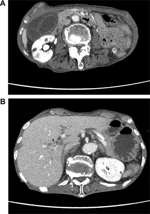 (A) Abdominal CT shows a poorly enhanced and thickened wall of the gallbladder. (B) Abdominal CT shows tiny bubbles in the intrahepatic portal venous branches.