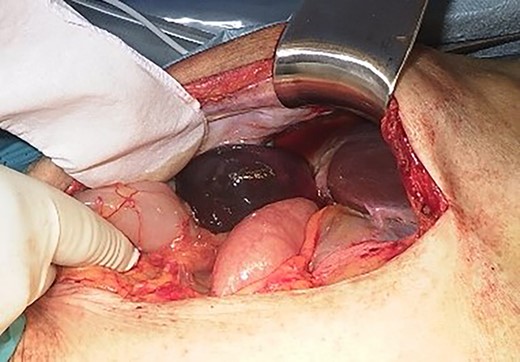 Intraoperative finding shows a gangrenous gallbladder with 180° clockwise rotation.