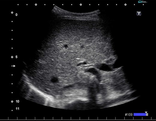 Ultrasonography after surgery shows no findings of PVG in the liver.
