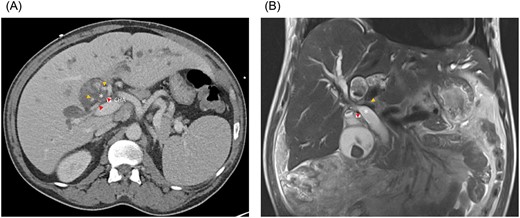 (A) Axial CT and (B) coronal MRI imaging showing the right anterior (orange arrowheads) and right posterior (red arrowheads) hepatic arteries encircling the common hepatic duct (white asterisk). CHA, common hepatic artery.