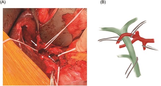 (A) Relationship between the common hepatic duct (asterisk) and the mobilized anterior (solid arrow) and posterior (dotted arrow) RHA branches. (B) Schematic representation of the RHA variant anatomy.