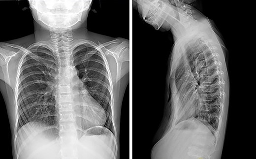Chest X-ray examination before the first operation.