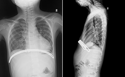 Chest X-ray examination after the first operation.